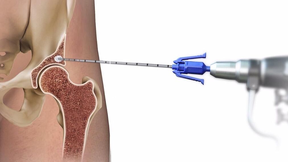 injections dans l'articulation de la hanche