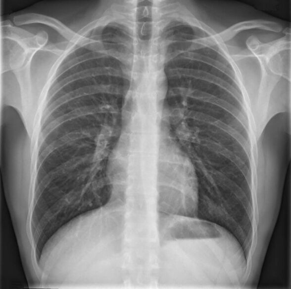 L'ostéochondrose de la colonne thoracique est diagnostiquée par radiographie