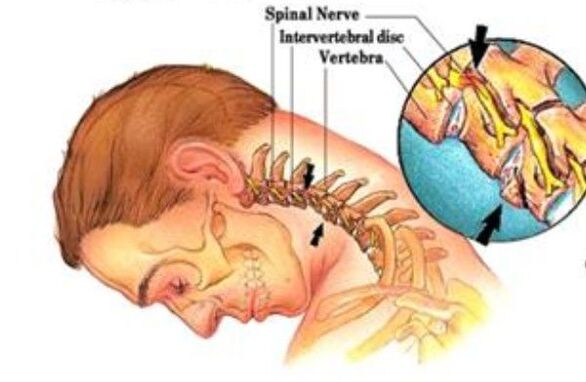 ostéochondrose cervicale