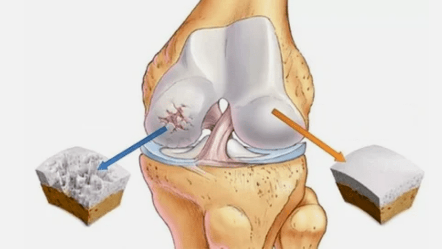 Comment l'arthrose se développe