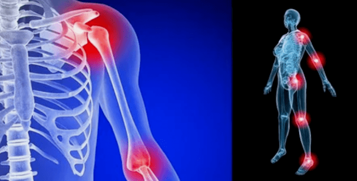 Déformation des arts pour l'arthrose