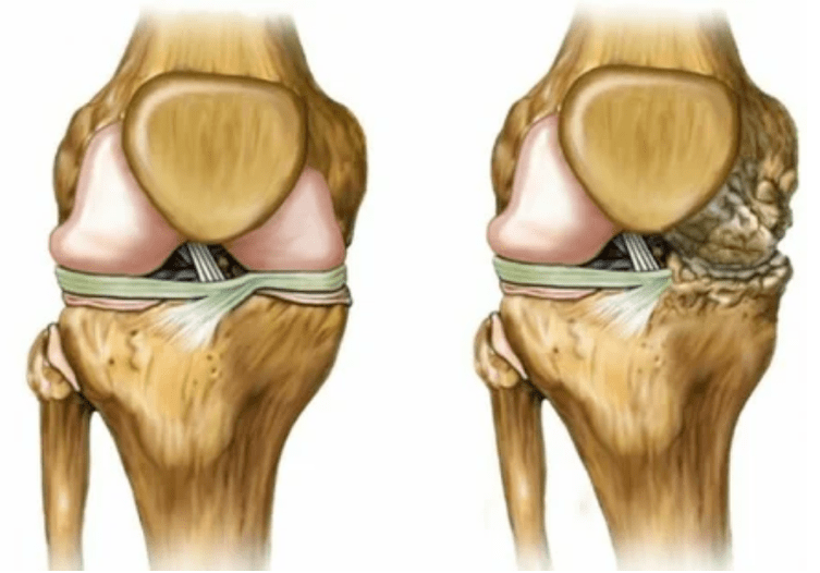 Phase d'arthrose