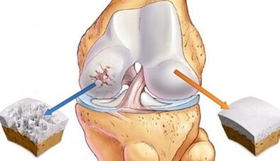 causes de l'arthrose des articulations
