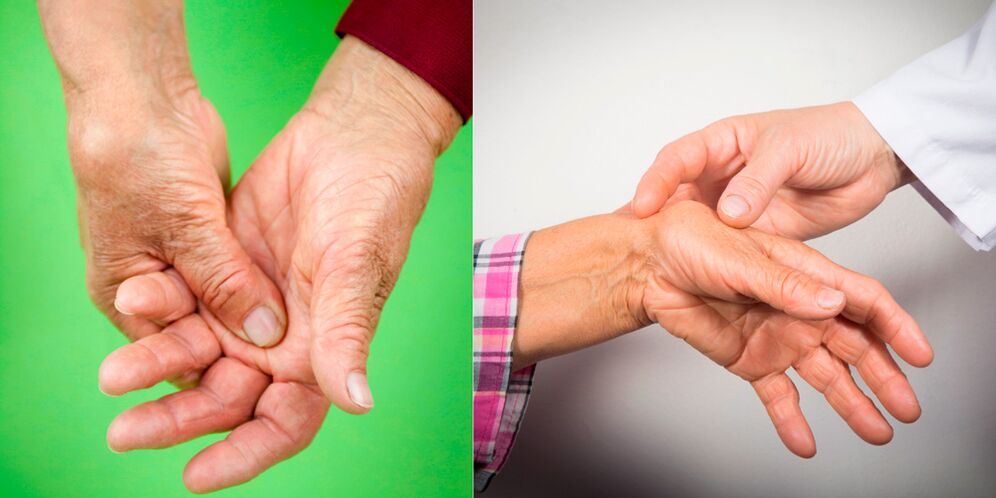 gonflement et douleurs douloureuses sont les premiers signes d'arthrite de la main