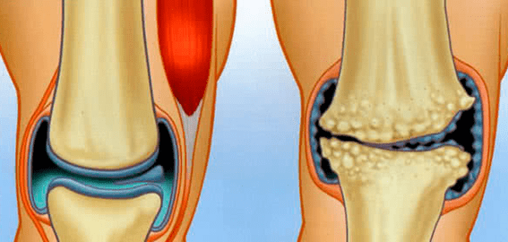 Articulation et arthrose normales